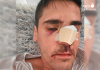 Imagen difundida por Fonsi Loaiza en sus redes sociales después de denunciar la agresión de la que fue víctima en Cádiz.